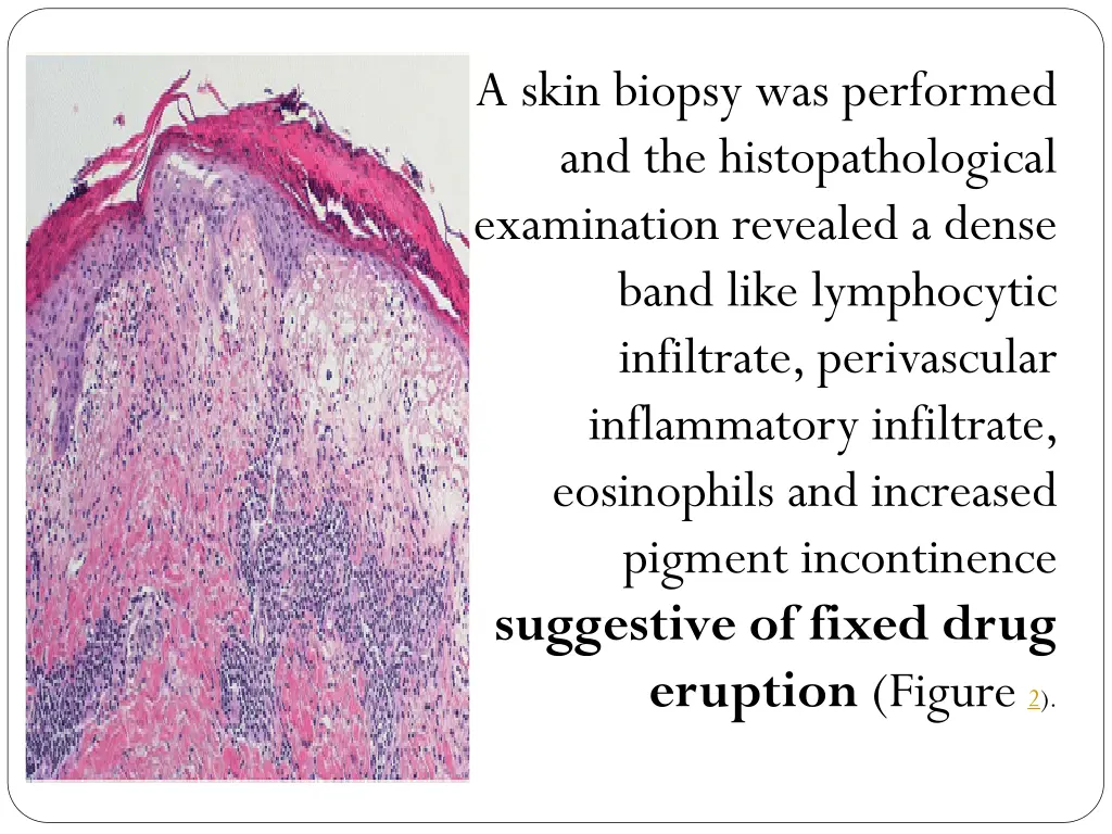 a skin biopsy was performed