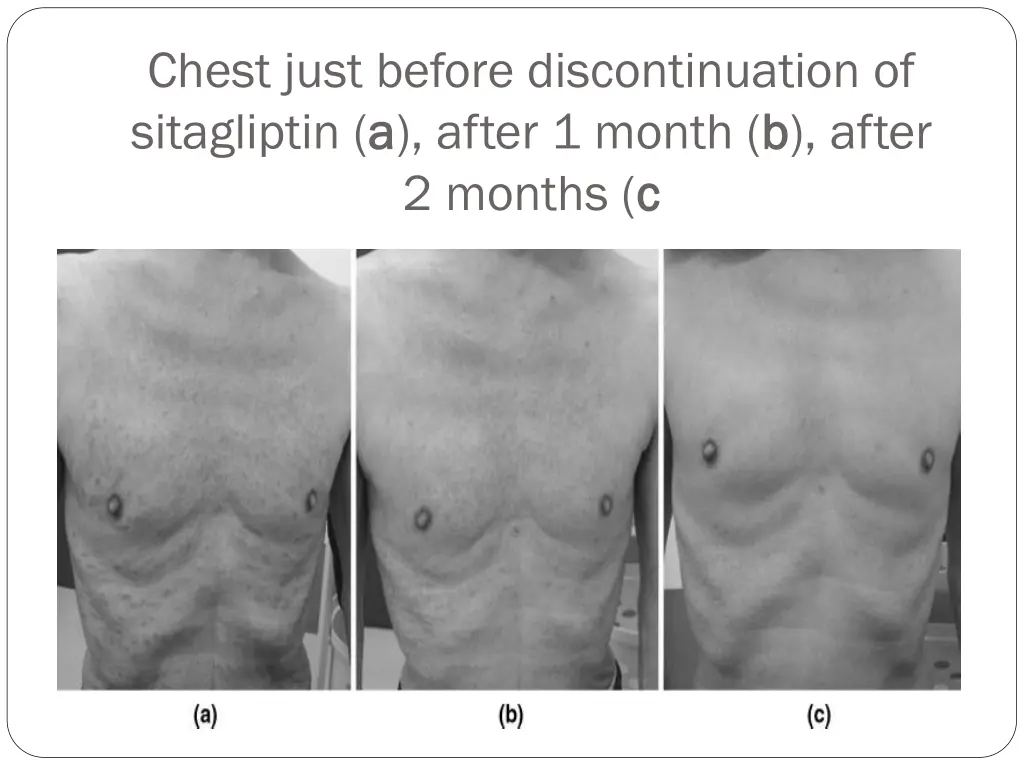 chest just before discontinuation of sitagliptin