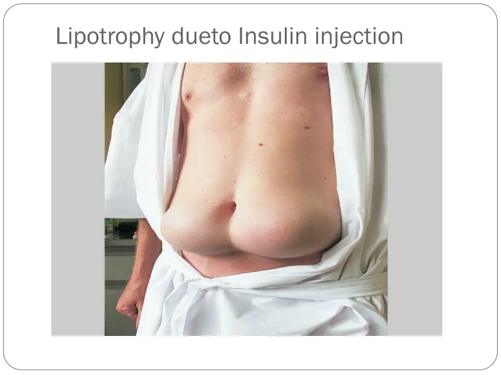 lipotrophy dueto insulin injection