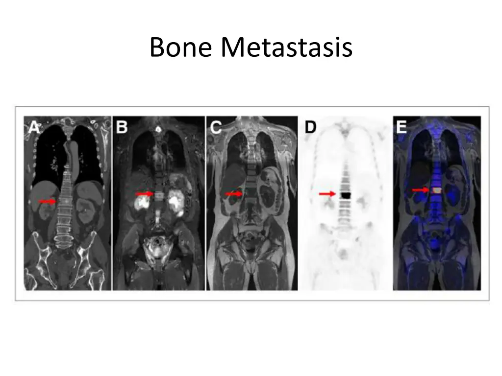 bone metastasis 7