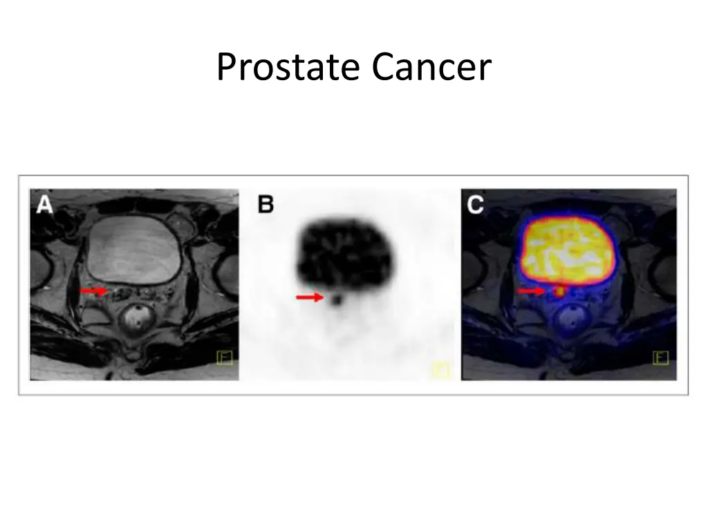 prostate cancer 12