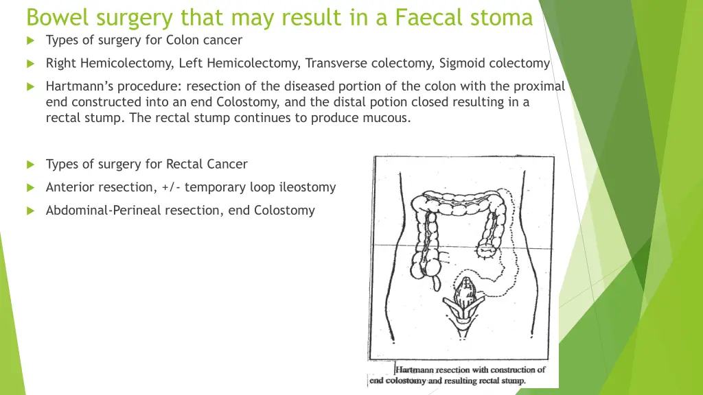 bowel surgery that may result in a faecal stoma