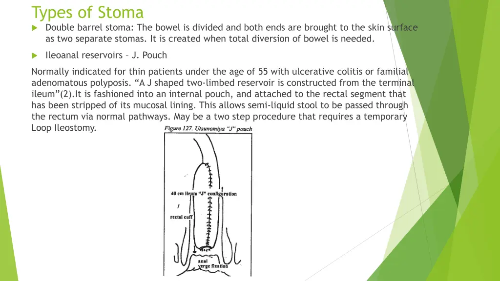 types of stoma double barrel stoma the bowel