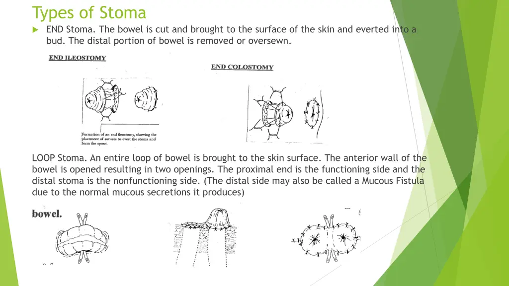 types of stoma end stoma the bowel