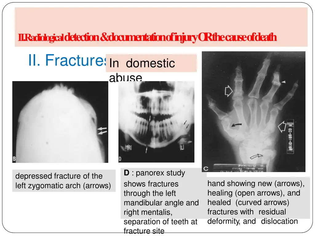 a radiology of injury ii fractur es in domestic