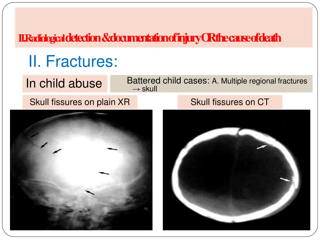 a radiology of injury ii fractures in child abuse 1