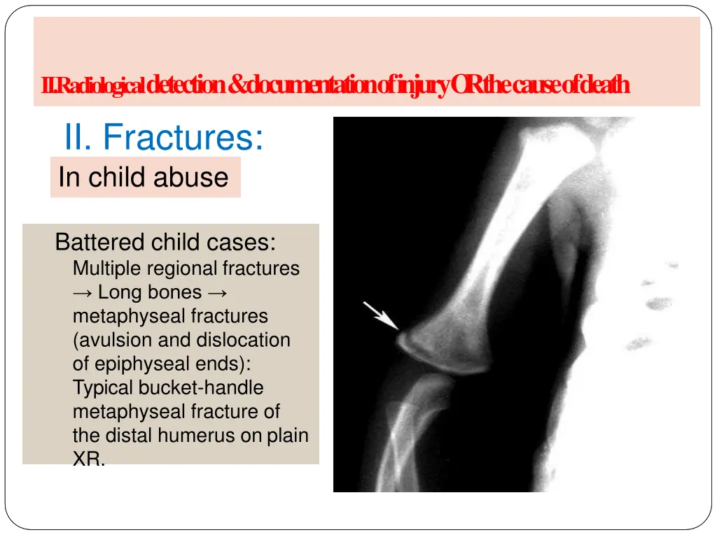 a radiology of injury ii fractures in child abuse 2