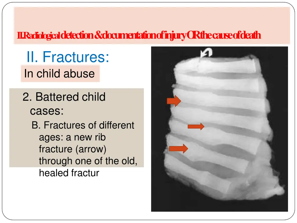 a radiology of injury ii fractures in child abuse 3