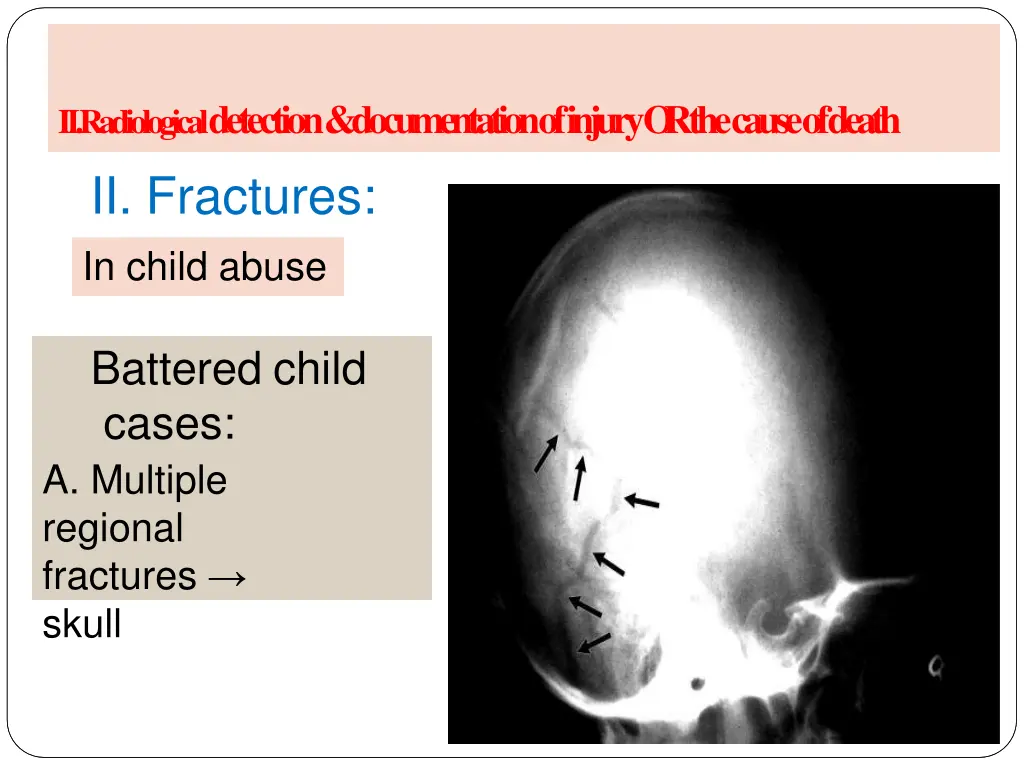 a radiology of injury ii fractures in child abuse