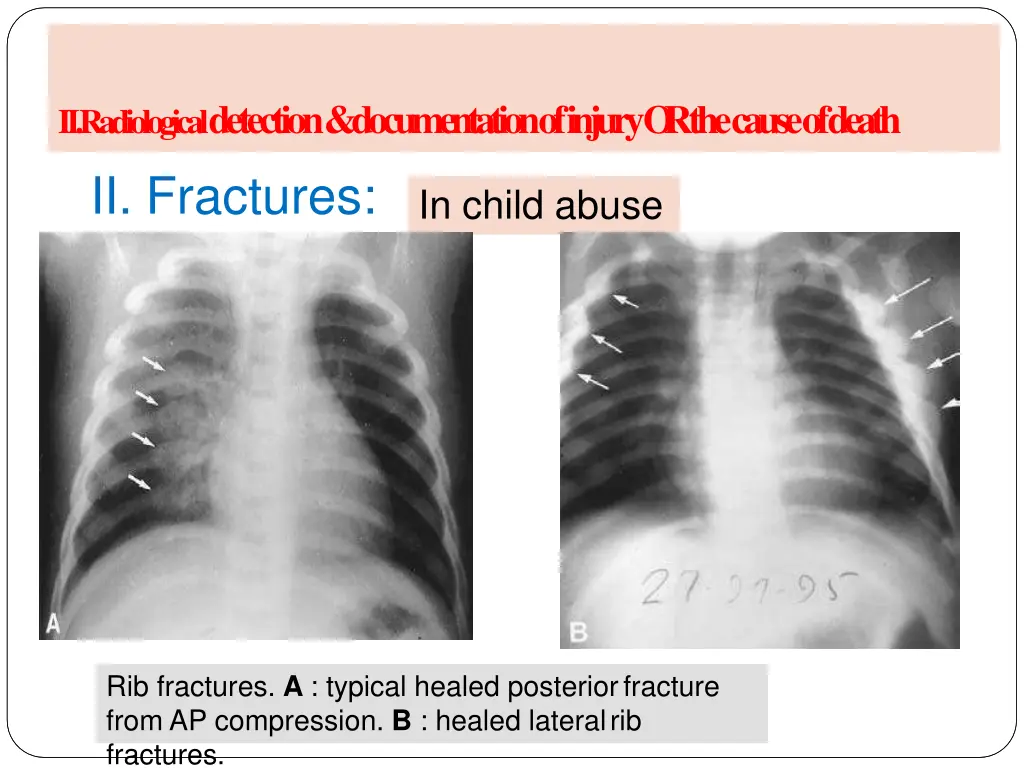 a radiology of injury ii fractures