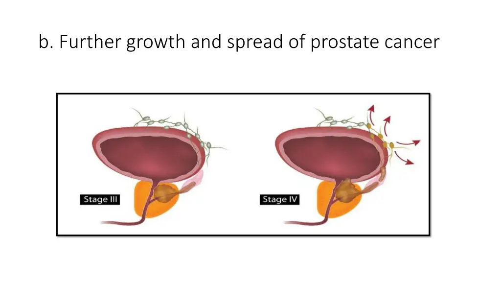 b further growth and spread of prostate cancer