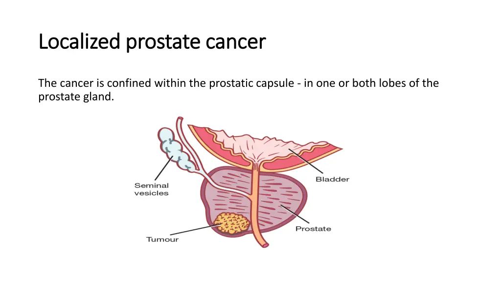 localized prostate cancer localized prostate