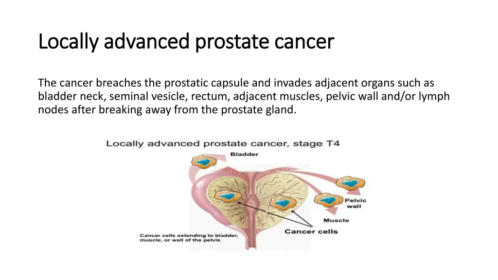 locally advanced prostate cancer locally advanced