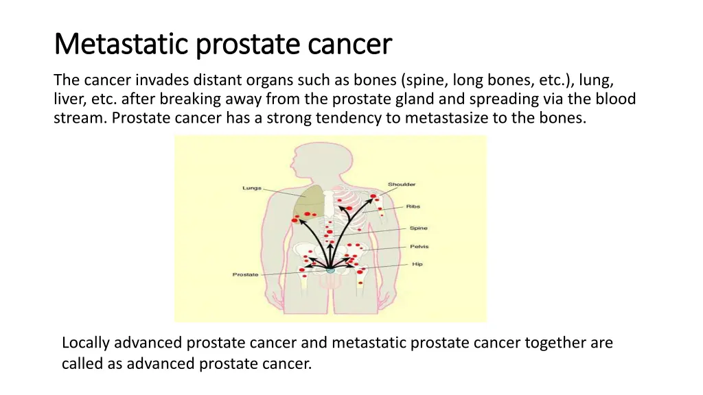 metastatic prostate cancer metastatic prostate