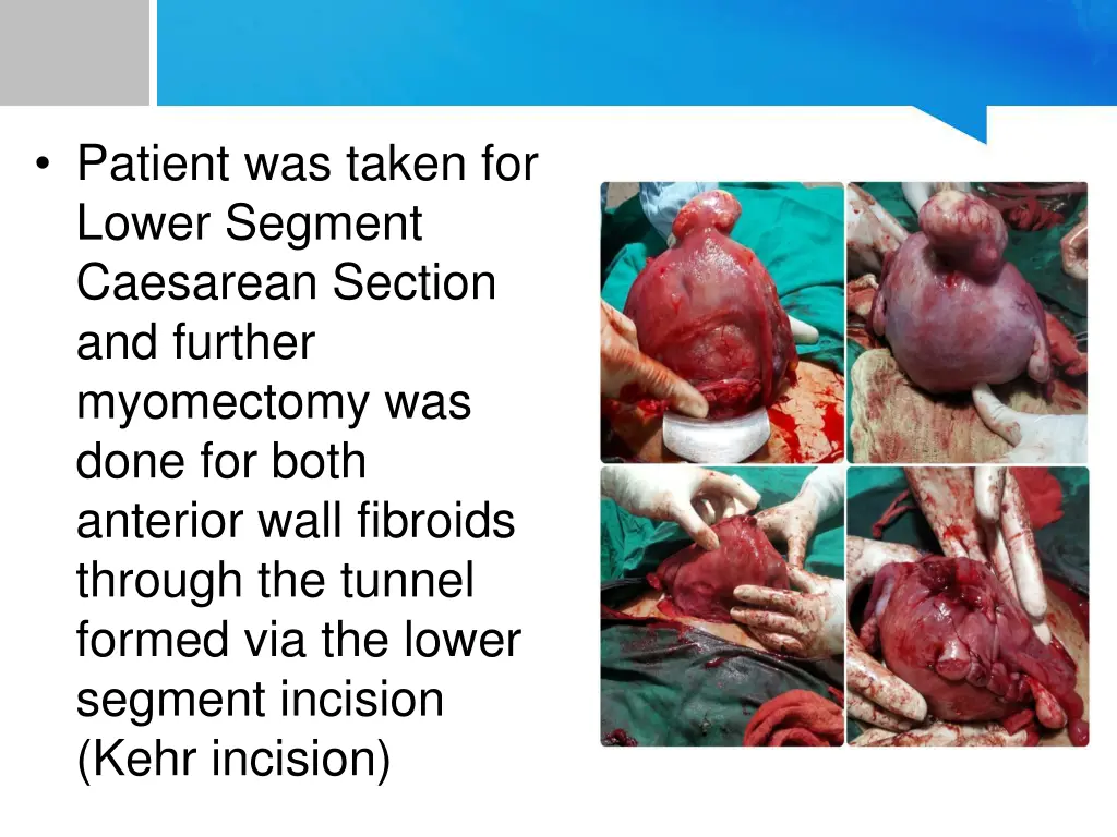 patient was taken for lower segment caesarean