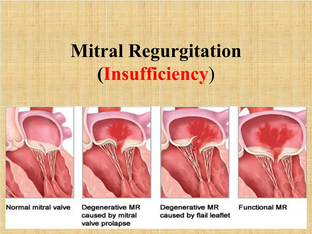 mitral regurgitation insufficiency