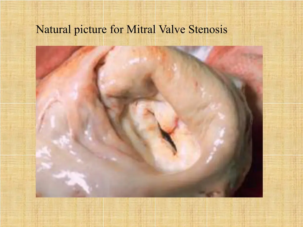 natural picture for mitral valve stenosis