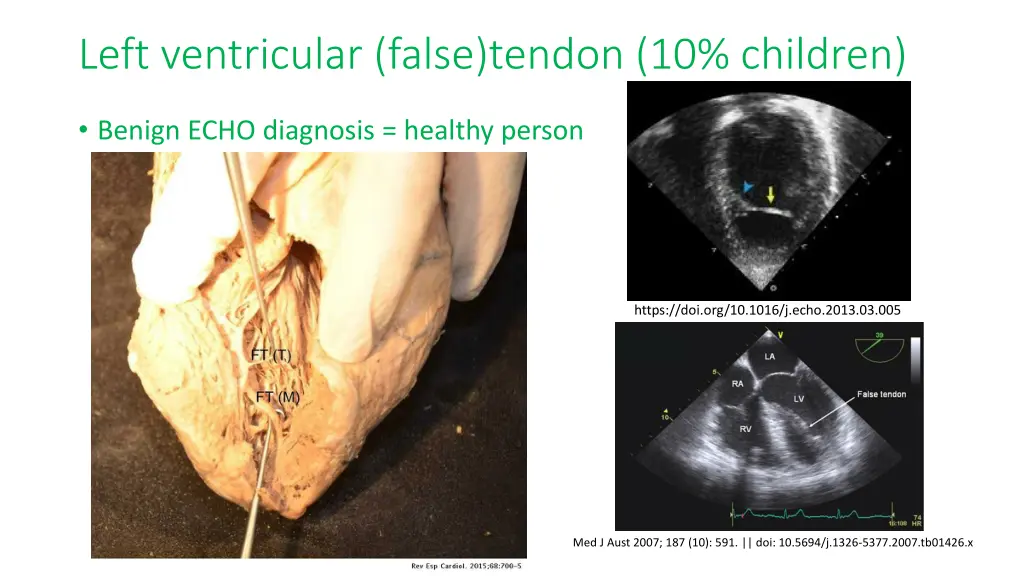 left ventricular false tendon 10 children