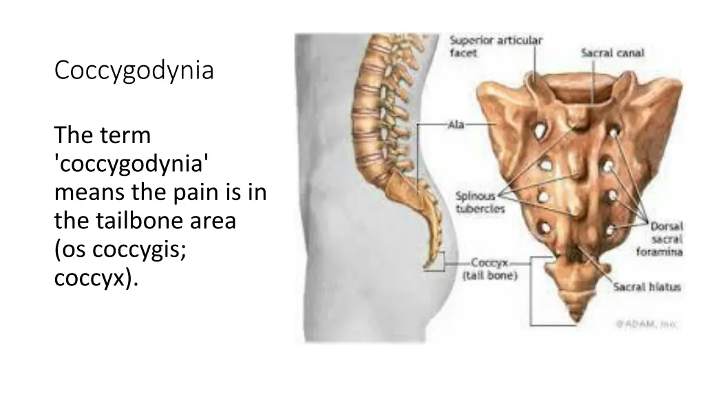 coccygodynia