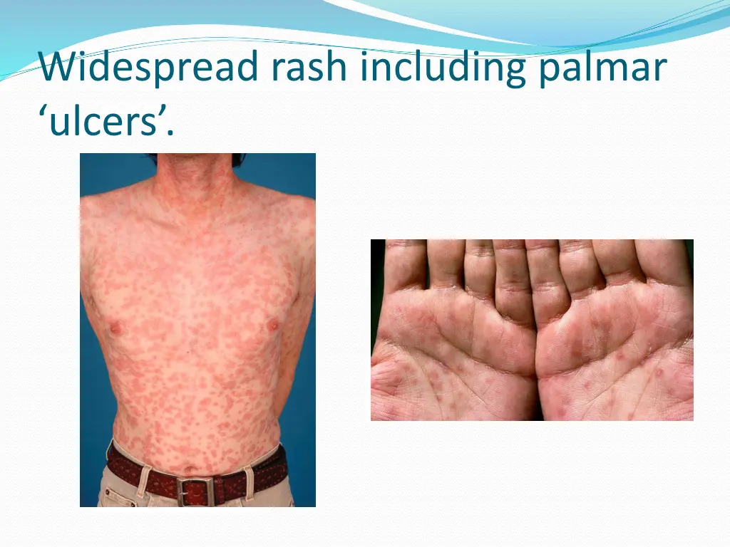 widespread rash including palmar ulcers