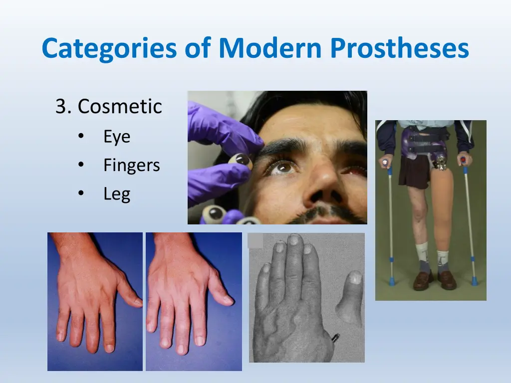 categories of modern prostheses 1