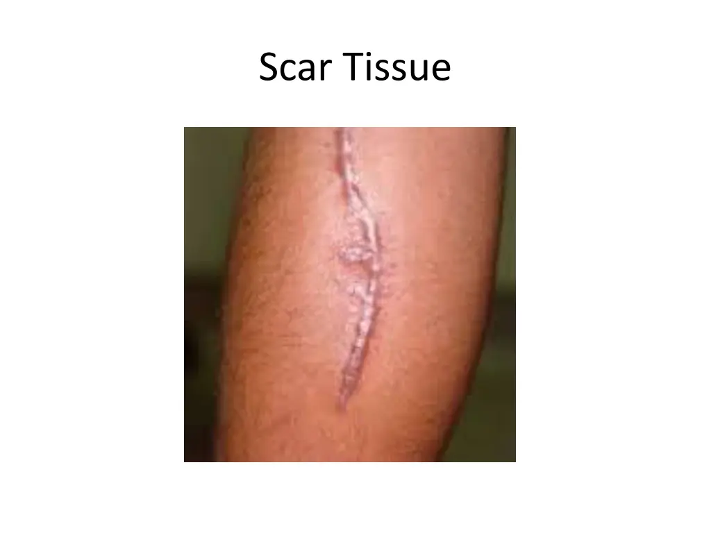 scar tissue