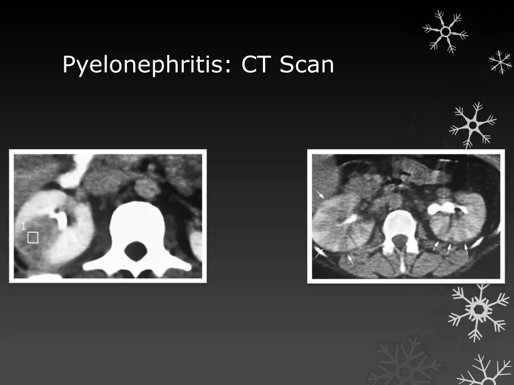 pyelonephritis ct scan 1