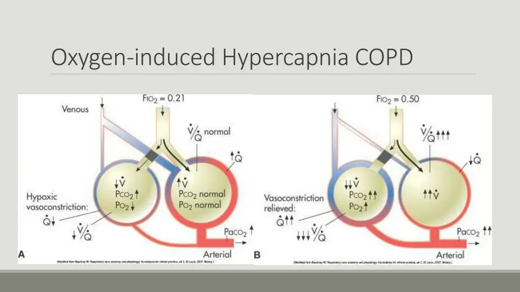 oxygen induced hypercapnia copd