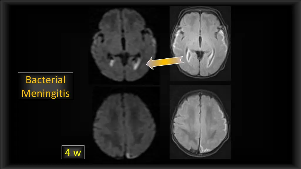 bacterial meningitis