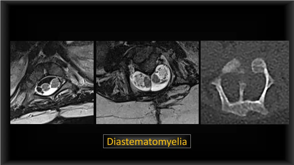 diastematomyelia