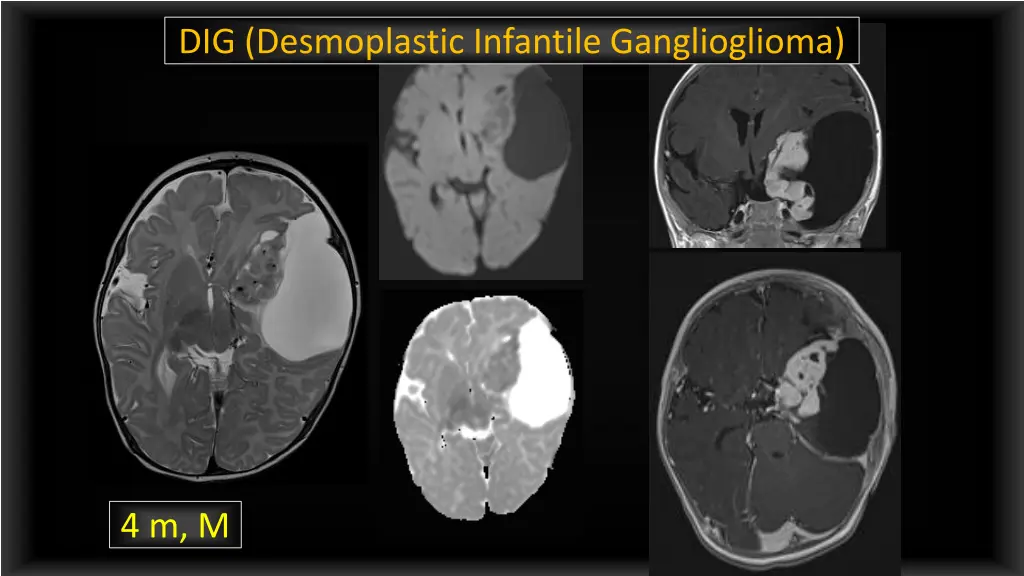 dig desmoplastic infantile ganglioglioma