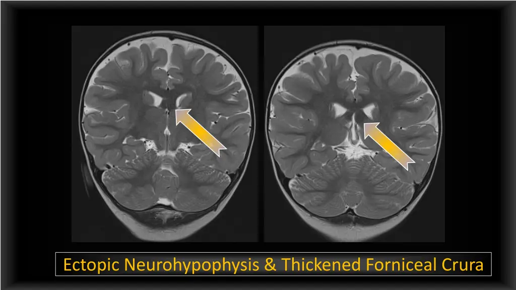 ectopic neurohypophysis thickened forniceal crura