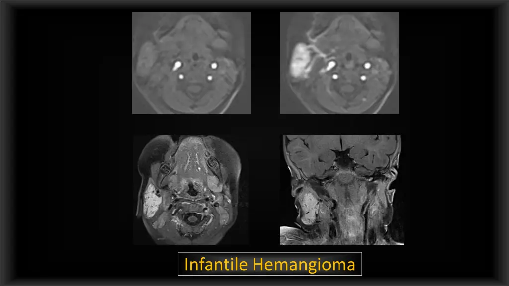 infantile hemangioma