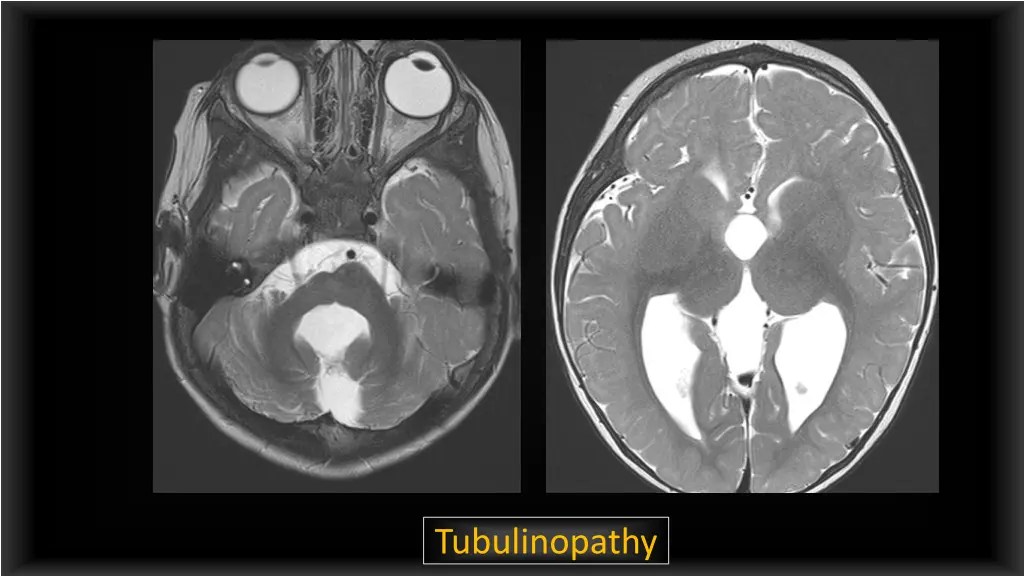 tubulinopathy