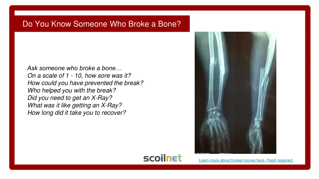 do you know someone who broke a bone