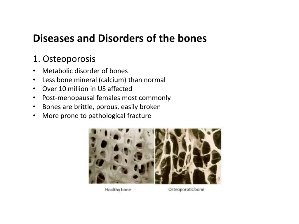 diseases and disorders of the bones