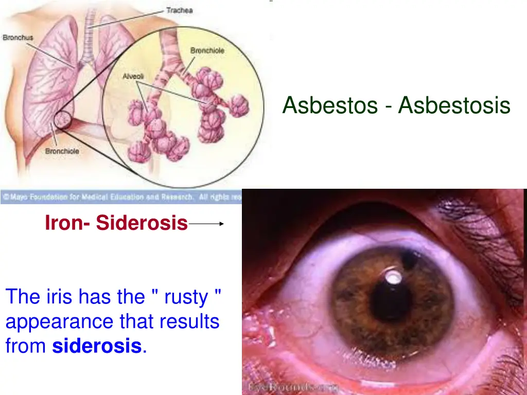 asbestos asbestosis