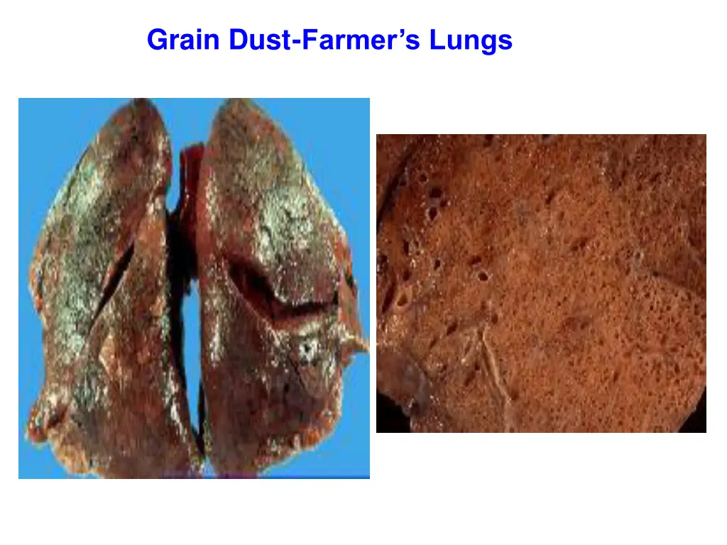 grain dust farmer s lungs