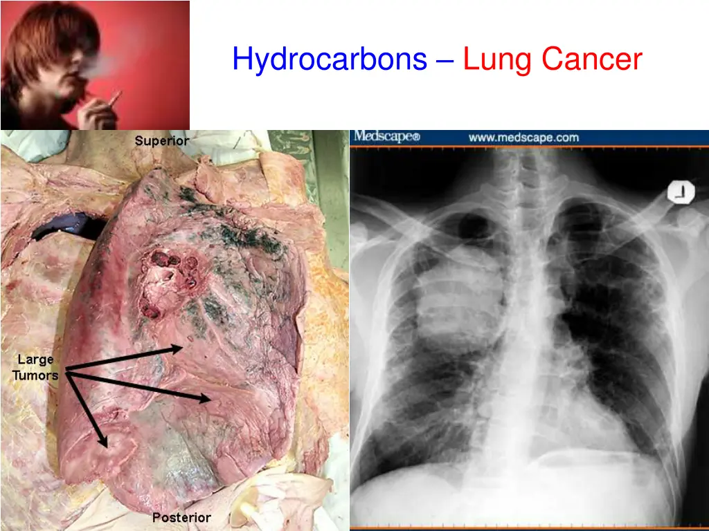 hydrocarbons lung cancer