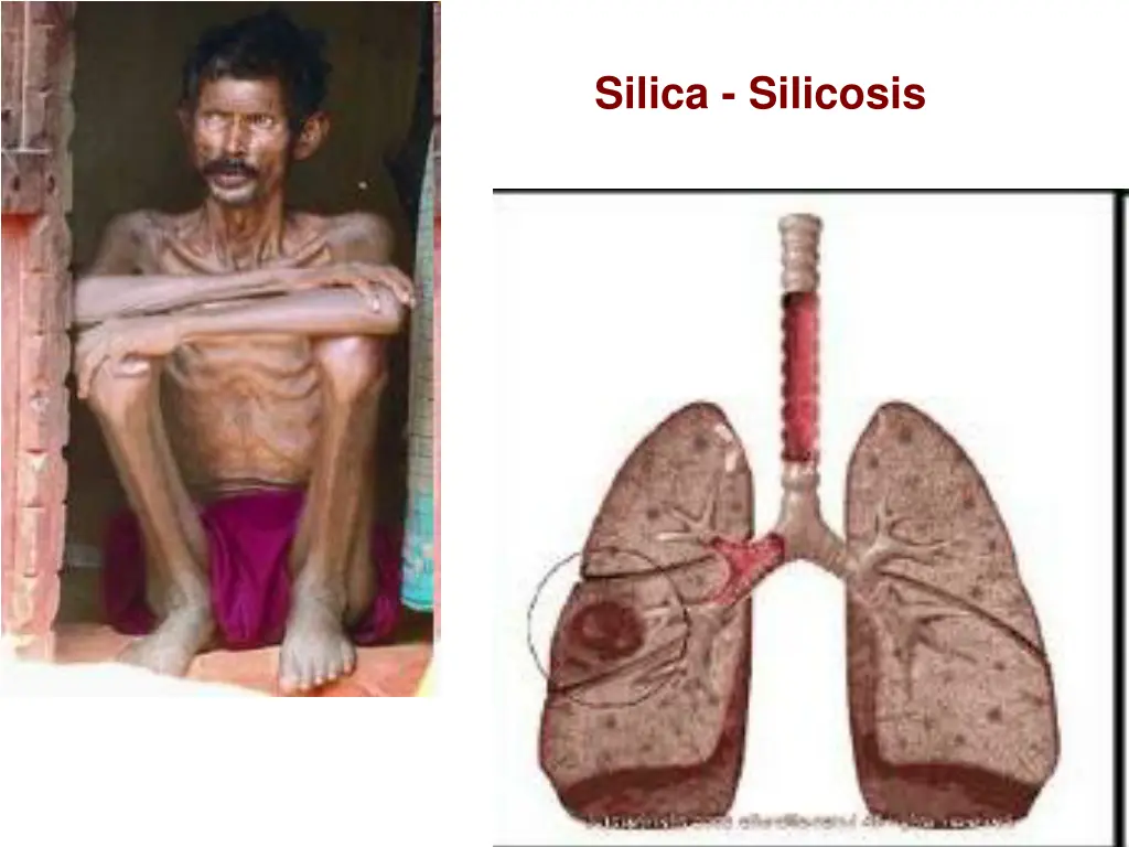 silica silicosis