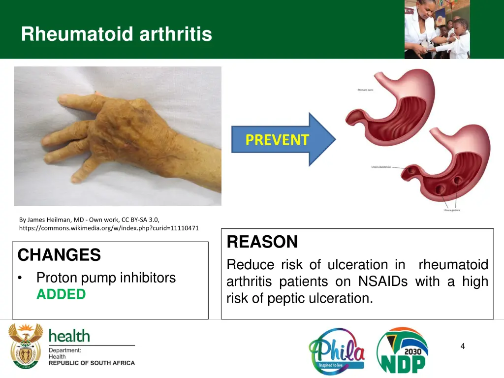 rheumatoid arthritis 1