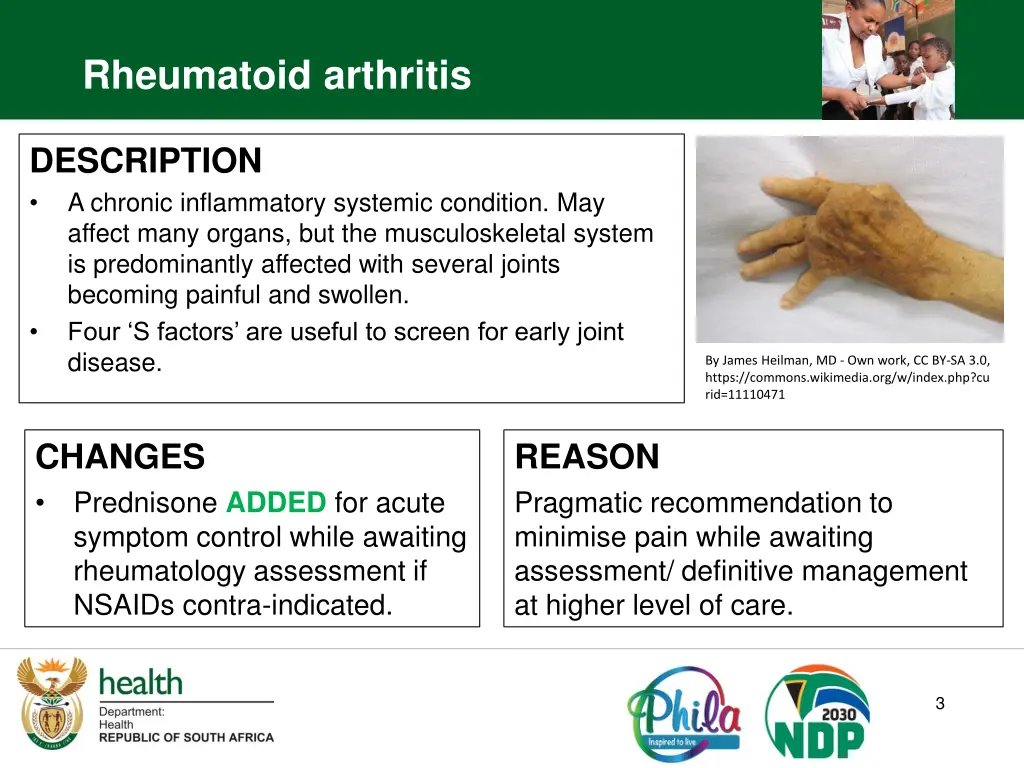 rheumatoid arthritis