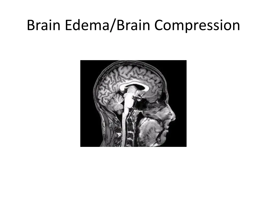 brain edema brain compression