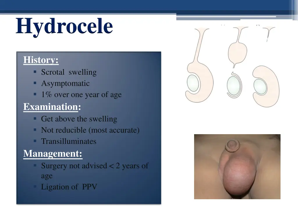 hydrocele