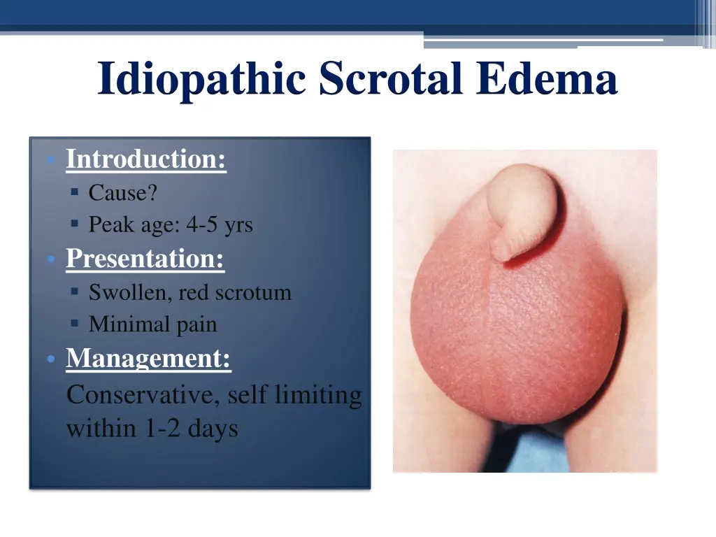 idiopathic scrotal edema