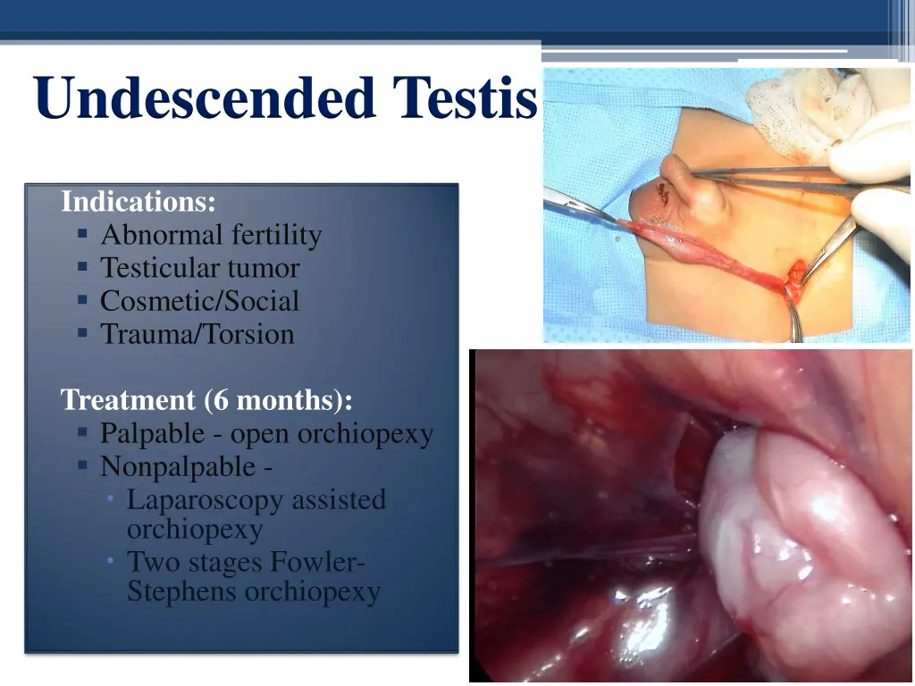 undescended testis 2