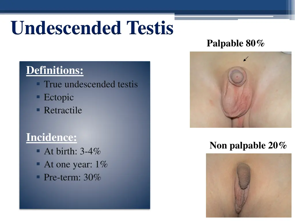 undescended testis