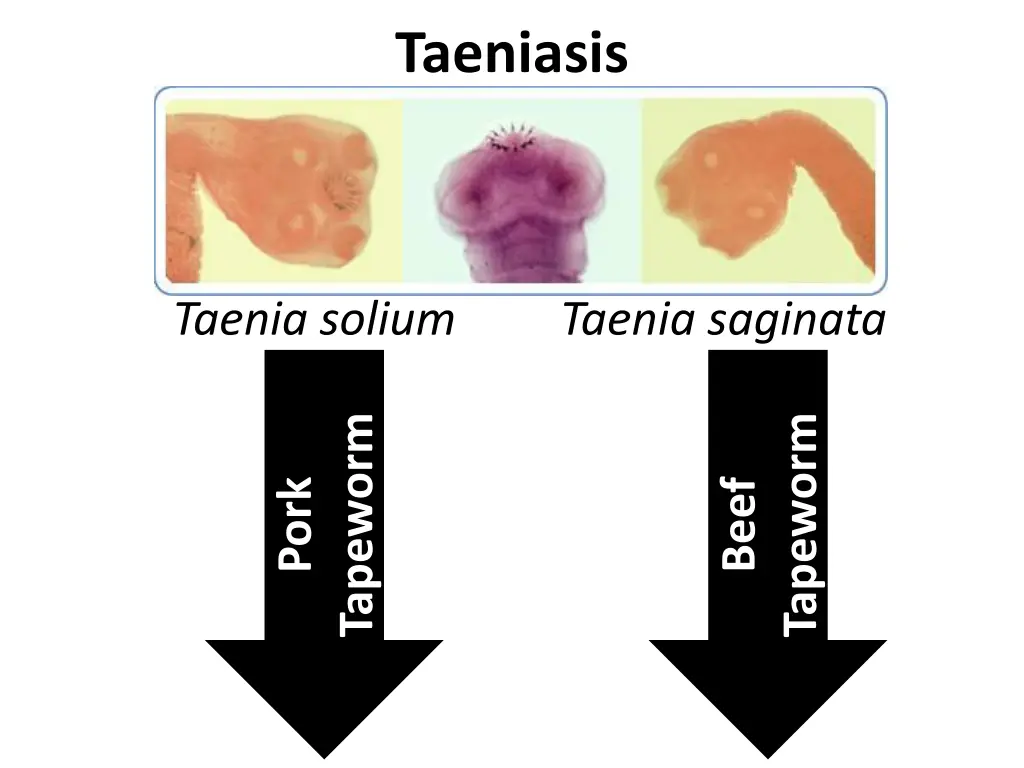 taeniasis