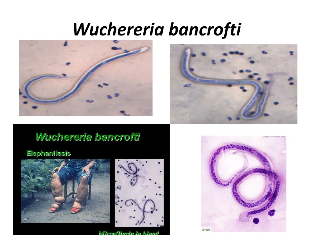 wuchereria bancrofti 1