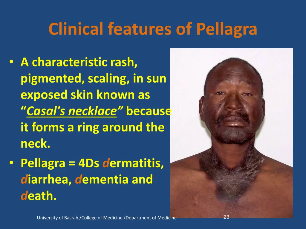 clinical features of pellagra 1